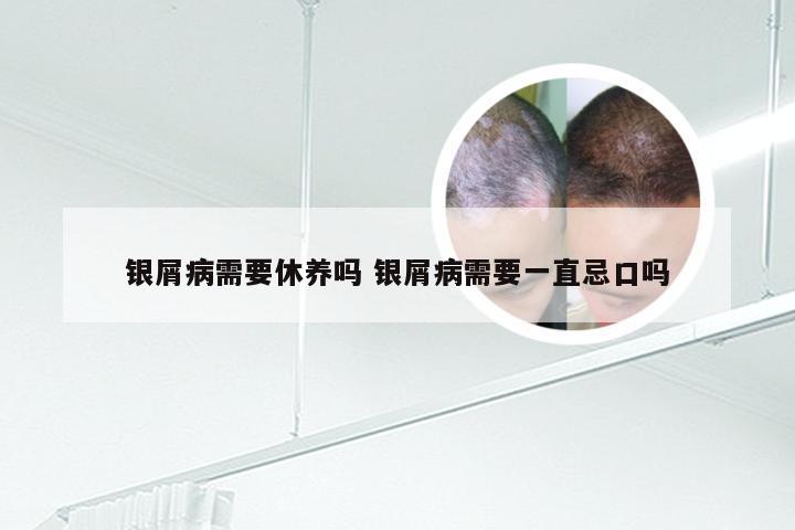 银屑病需要休养吗 银屑病需要一直忌口吗