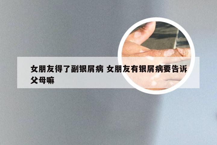 女朋友得了副银屑病 女朋友有银屑病要告诉父母嘛