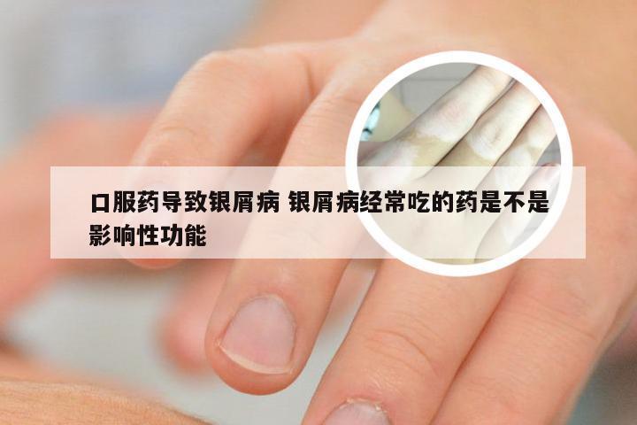口服药导致银屑病 银屑病经常吃的药是不是影响性功能