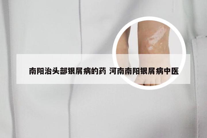 南阳治头部银屑病的药 河南南阳银屑病中医