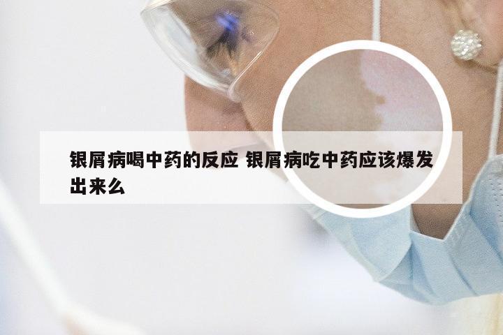 银屑病喝中药的反应 银屑病吃中药应该爆发出来么
