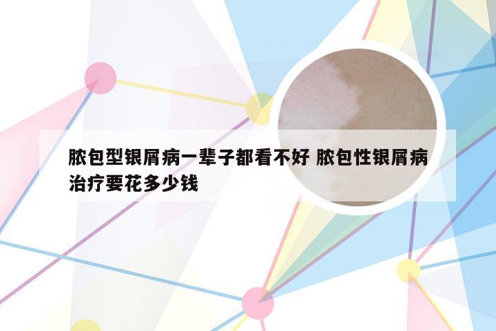脓包型银屑病一辈子都看不好 脓包性银屑病治疗要花多少钱