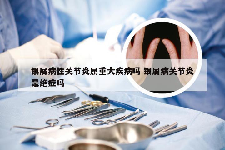 银屑病性关节炎属重大疾病吗 银屑病关节炎是绝症吗