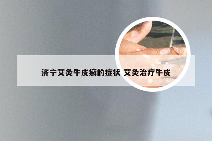 济宁艾灸牛皮癣的症状 艾灸治疗牛皮
