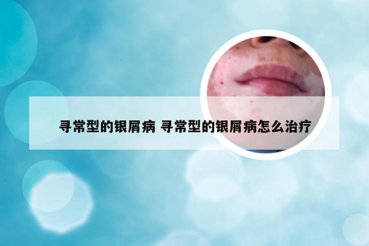 寻常型的银屑病 寻常型的银屑病怎么治疗