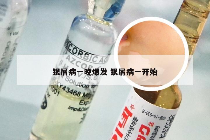 银屑病一晚爆发 银屑病一开始