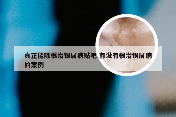 真正能除根治银屑病贴吧 有没有根治银屑病的案例