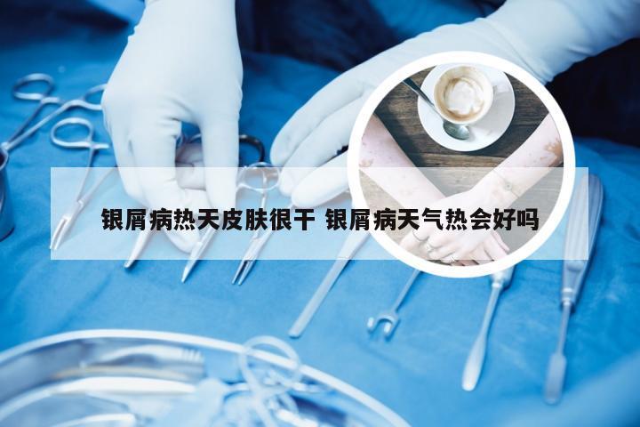 银屑病热天皮肤很干 银屑病天气热会好吗