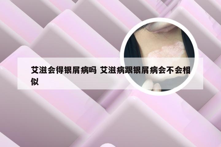 艾滋会得银屑病吗 艾滋病跟银屑病会不会相似
