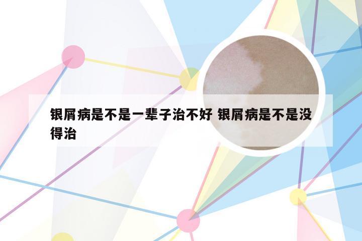 银屑病是不是一辈子治不好 银屑病是不是没得治