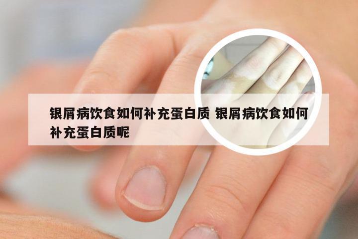 银屑病饮食如何补充蛋白质 银屑病饮食如何补充蛋白质呢