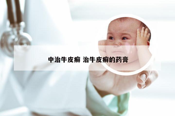 中治牛皮癣 治牛皮癣的药膏
