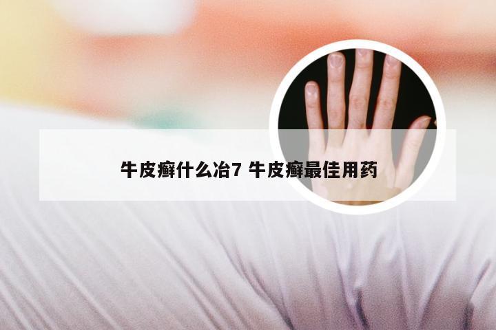 牛皮癣什么冶7 牛皮癣最佳用药