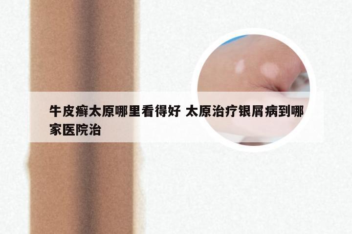 牛皮癣太原哪里看得好 太原治疗银屑病到哪家医院治