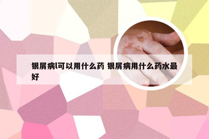 银屑病l可以用什么药 银屑病用什么药水最好