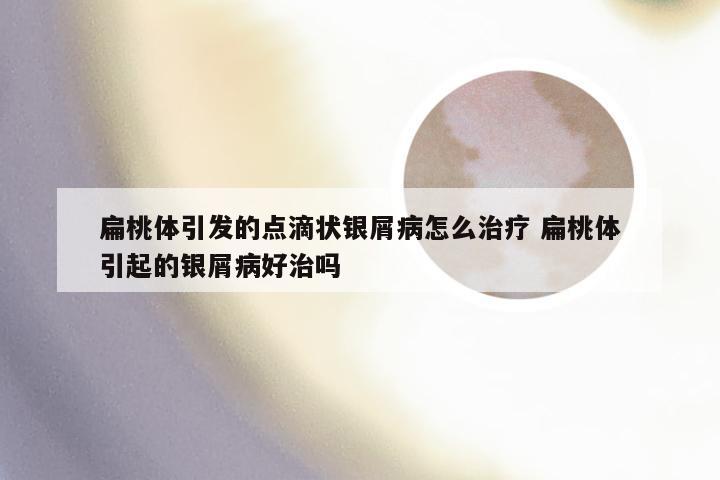 扁桃体引发的点滴状银屑病怎么治疗 扁桃体引起的银屑病好治吗