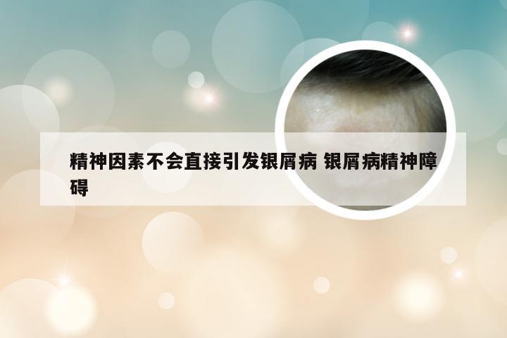 精神因素不会直接引发银屑病 银屑病精神障碍