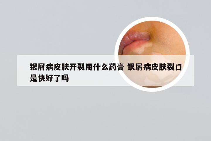 银屑病皮肤开裂用什么药膏 银屑病皮肤裂口是快好了吗