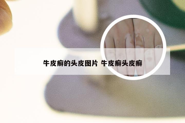 牛皮癣的头皮图片 牛皮癣头皮癣