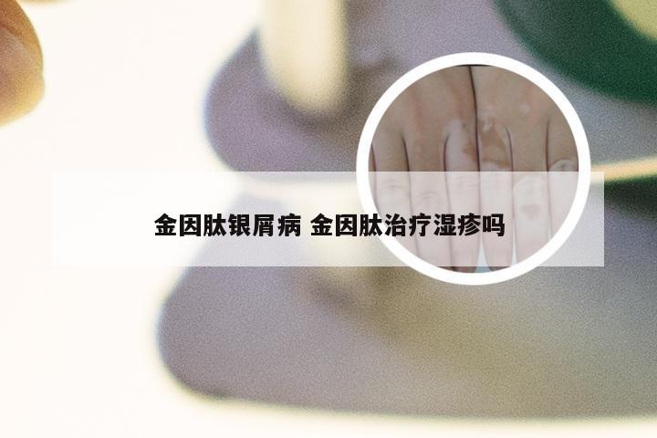 金因肽银屑病 金因肽治疗湿疹吗