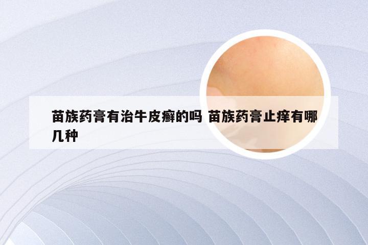 苗族药膏有治牛皮癣的吗 苗族药膏止痒有哪几种