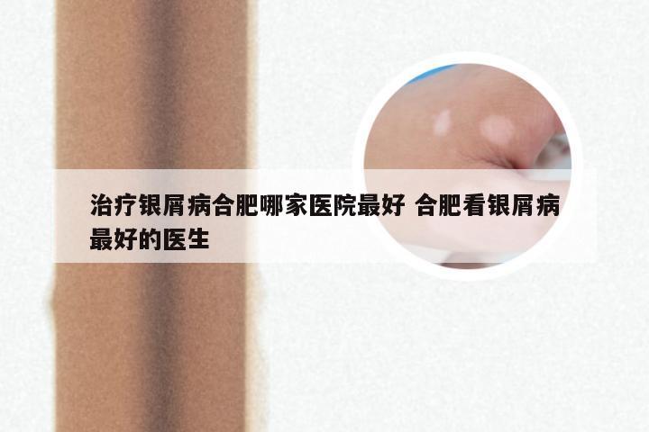 治疗银屑病合肥哪家医院最好 合肥看银屑病最好的医生