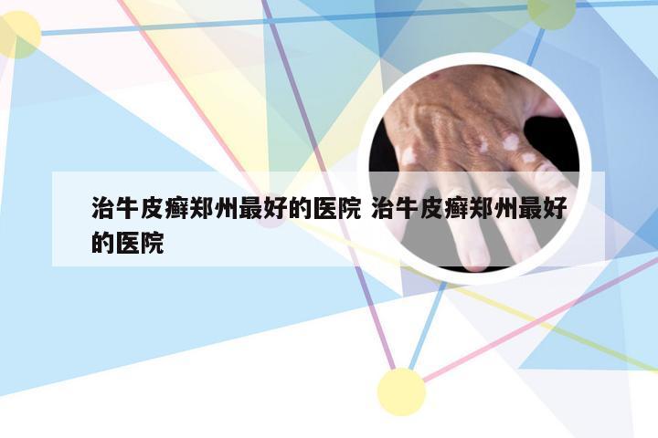治牛皮癣郑州最好的医院 治牛皮癣郑州最好的医院