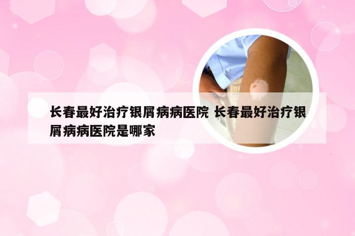 长春最好治疗银屑病病医院 长春最好治疗银屑病病医院是哪家