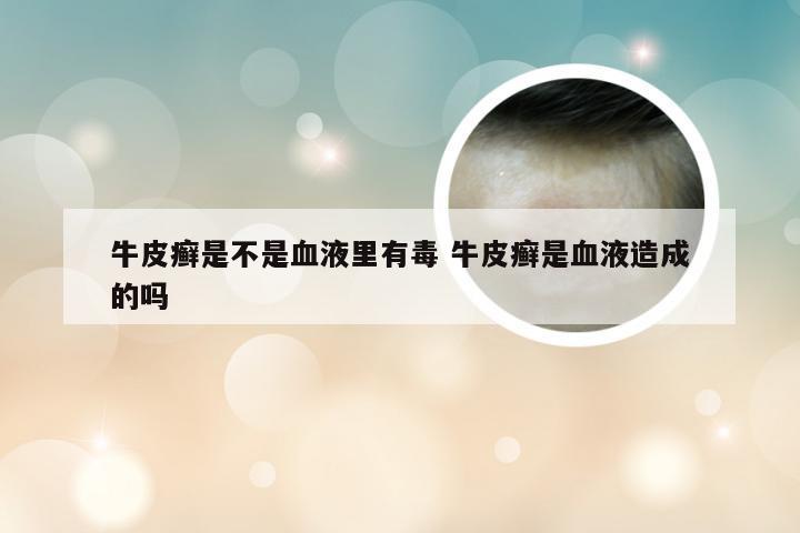 牛皮癣是不是血液里有毒 牛皮癣是血液造成的吗
