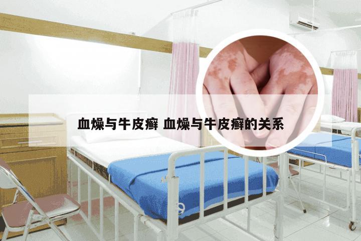 血燥与牛皮癣 血燥与牛皮癣的关系
