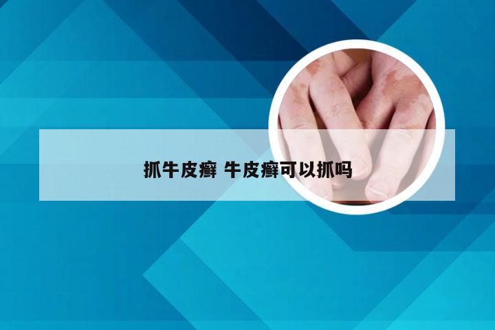 抓牛皮癣 牛皮癣可以抓吗