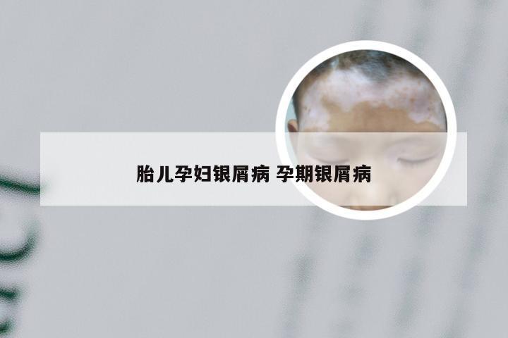 胎儿孕妇银屑病 孕期银屑病