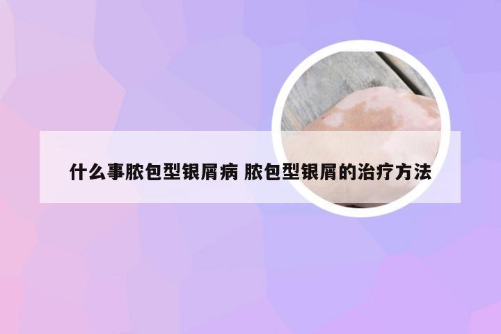 什么事脓包型银屑病 脓包型银屑的治疗方法