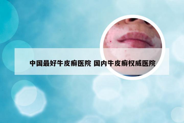 中国最好牛皮癣医院 国内牛皮癣权威医院