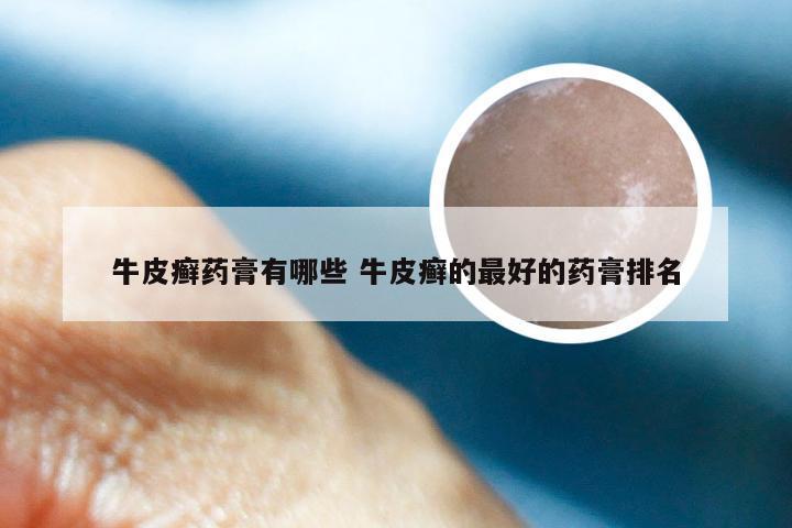 牛皮癣药膏有哪些 牛皮癣的最好的药膏排名
