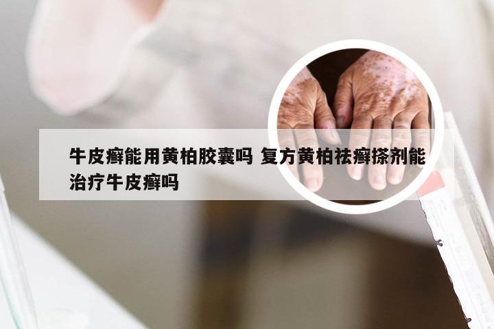 牛皮癣能用黄柏胶囊吗 复方黄柏祛癣搽剂能治疗牛皮癣吗
