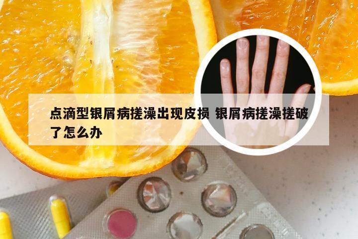点滴型银屑病搓澡出现皮损 银屑病搓澡搓破了怎么办