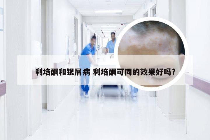 利培酮和银屑病 利培酮可同的效果好吗?