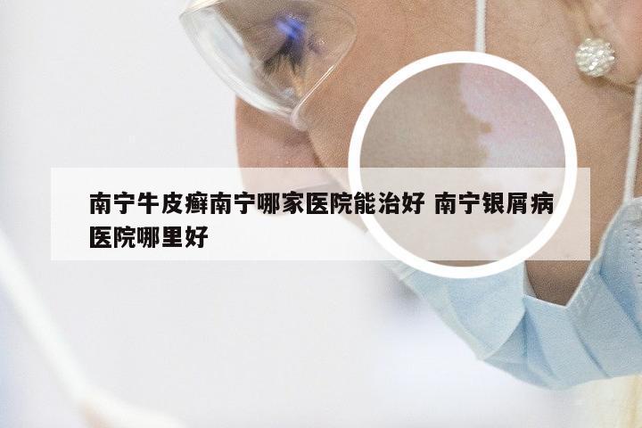 南宁牛皮癣南宁哪家医院能治好 南宁银屑病医院哪里好