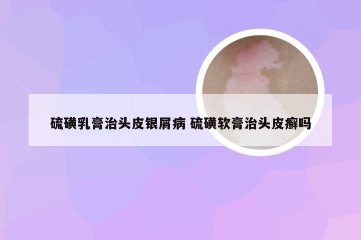 硫磺乳膏治头皮银屑病 硫磺软膏治头皮癣吗
