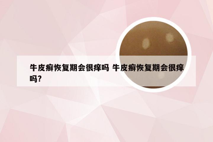 牛皮癣恢复期会很痒吗 牛皮癣恢复期会很痒吗?