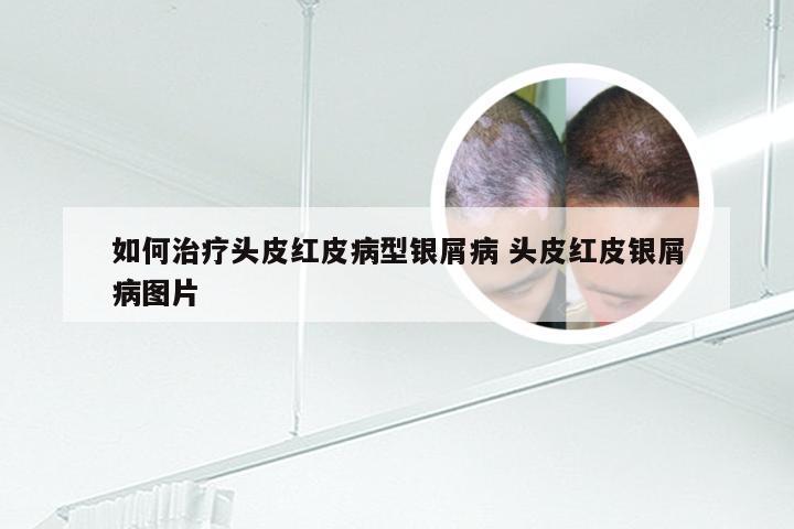 如何治疗头皮红皮病型银屑病 头皮红皮银屑病图片