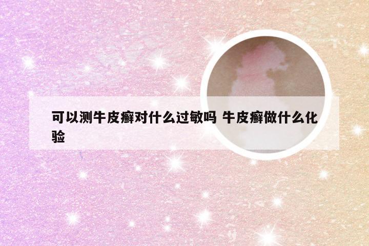 可以测牛皮癣对什么过敏吗 牛皮癣做什么化验