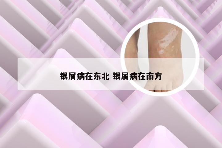 银屑病在东北 银屑病在南方
