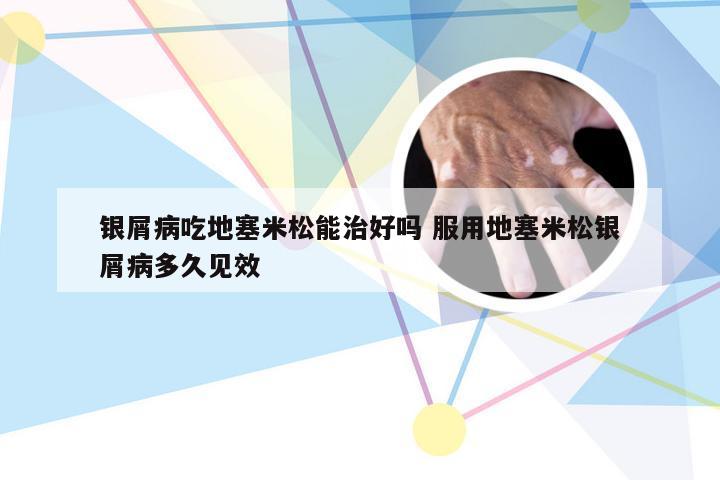 银屑病吃地塞米松能治好吗 服用地塞米松银屑病多久见效
