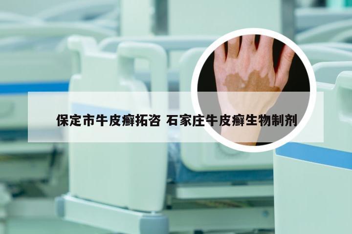 保定市牛皮癣拓咨 石家庄牛皮癣生物制剂