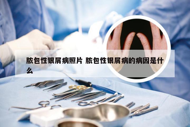 脓包性银屑病照片 脓包性银屑病的病因是什么