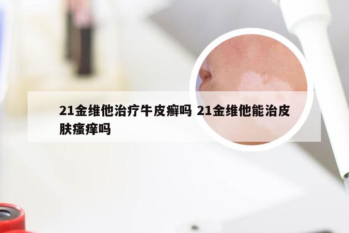 21金维他治疗牛皮癣吗 21金维他能治皮肤瘙痒吗