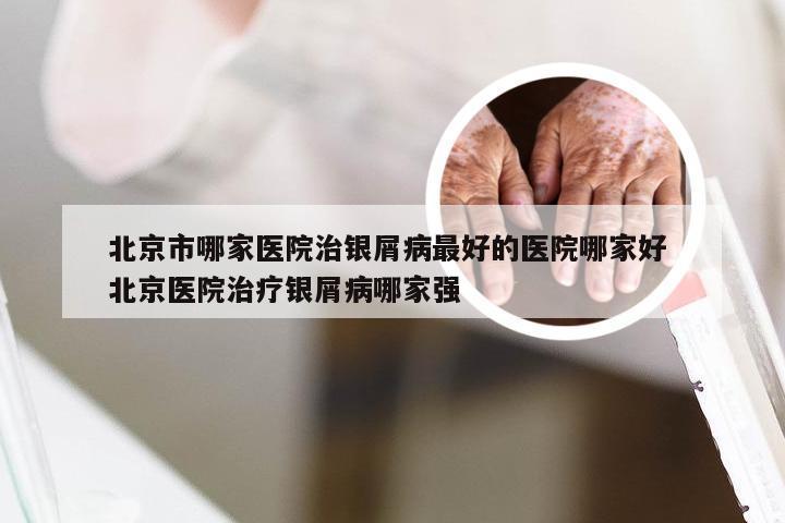 北京市哪家医院治银屑病最好的医院哪家好 北京医院治疗银屑病哪家强
