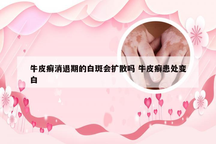 牛皮癣消退期的白斑会扩散吗 牛皮癣患处变白